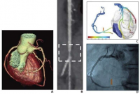 快速现场FFR-CT算法有助于促进临床采用