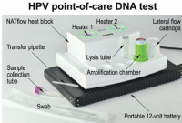 DNA 测试可以扩大宫颈癌筛查的范围