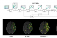 团队开发新的几何深度学习模型来检测中风病变