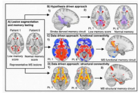 与常见脑回路相关的多发性硬化症记忆丧失相关的脑损伤