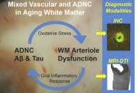 关于阿尔茨海默病白质损伤的研究报告