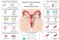 四种新受体可能将子宫内膜癌与多囊卵巢综合症联系起来