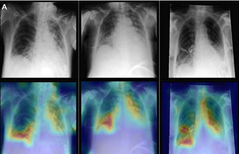 AI 将胸部 X 光检查与患者数据相结合以改善诊断
