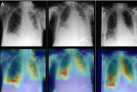 AI 将胸部 X 光检查与患者数据相结合以改善诊断
