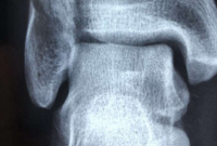 研究发现急性焦磷酸钙沉积性关节炎使骨折风险加倍