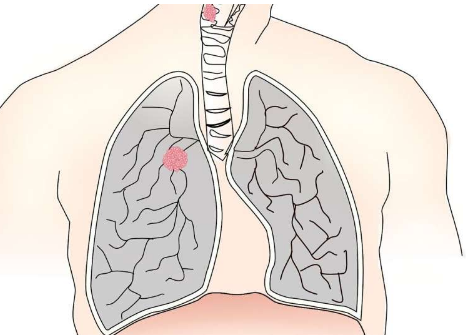免疫治疗药物在身体功能有限的肺癌患者中具有良好的耐受性