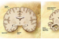 一组生物标志物可以预测早期阿尔茨海默病