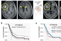嵌合抗原受体 T 细胞疗法在侵袭性脑肿瘤患者中显示出临床活性