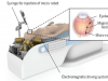研究人员开发电磁驱动系统以增强眼内显微手术