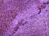 MicroRNA帮助癌症逃避免疫系统