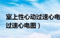 室上性心动过速心电图有p波吗（室上性心动过速心电图）