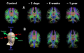 先进的 MRI 扫描可帮助识别三分之一患有隐藏疾病的脑震荡患者