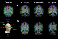 先进的 MRI 扫描可帮助识别三分之一患有隐藏疾病的脑震荡患者