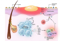研究人员确定了导致痤疮病变的细胞通路失调