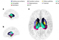 大规模脑容量研究发现帕金森病和多动症与遗传相关