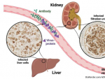 揭示肝炎与肾脏损害之间的联系